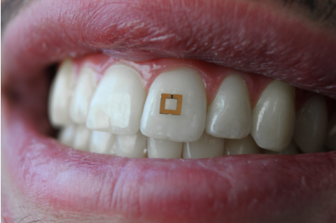 A close-up of a mouth with teeth. One tooth has a square gold sensor on it.