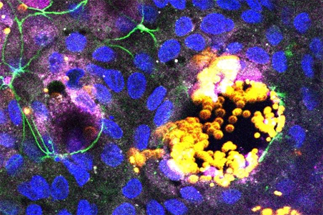 Microplastic particles (yellow) are absorbed by M cells (magenta) in a lab model of human intestinal lining. Green outlines indicate intact membranes for epithelial cells, which cover and protect the interior of the intestines. Cell nuclei are shown in blue. Image: Courtesy of Ying Chen 