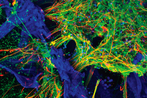 3D brain tissue culture: neurons (green) from an Alzheimer’s disease patient populate a porous matrix of silk protein and collagen (blue), along with astrocytes (cell markers indicated in red). Image scale: 460 microns across.