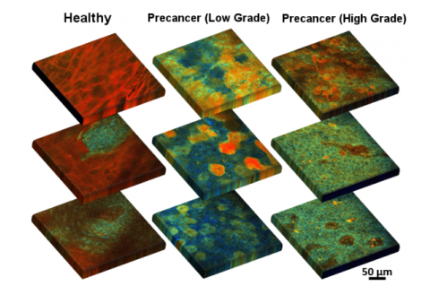 Optical fluorescence scans of excised healthy and precancerous cervical epithelial tissue.