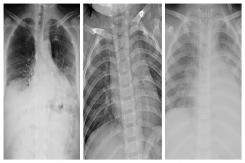 Lung X-ray images, from left, of COVID-19, normal, and viral pneumonia patients.