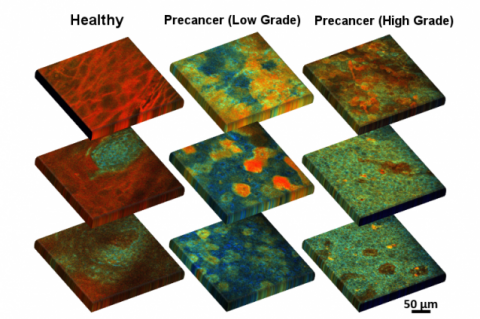 Optical fluorescence scans of excised healthy and precancerous cervical epithelial tissue.